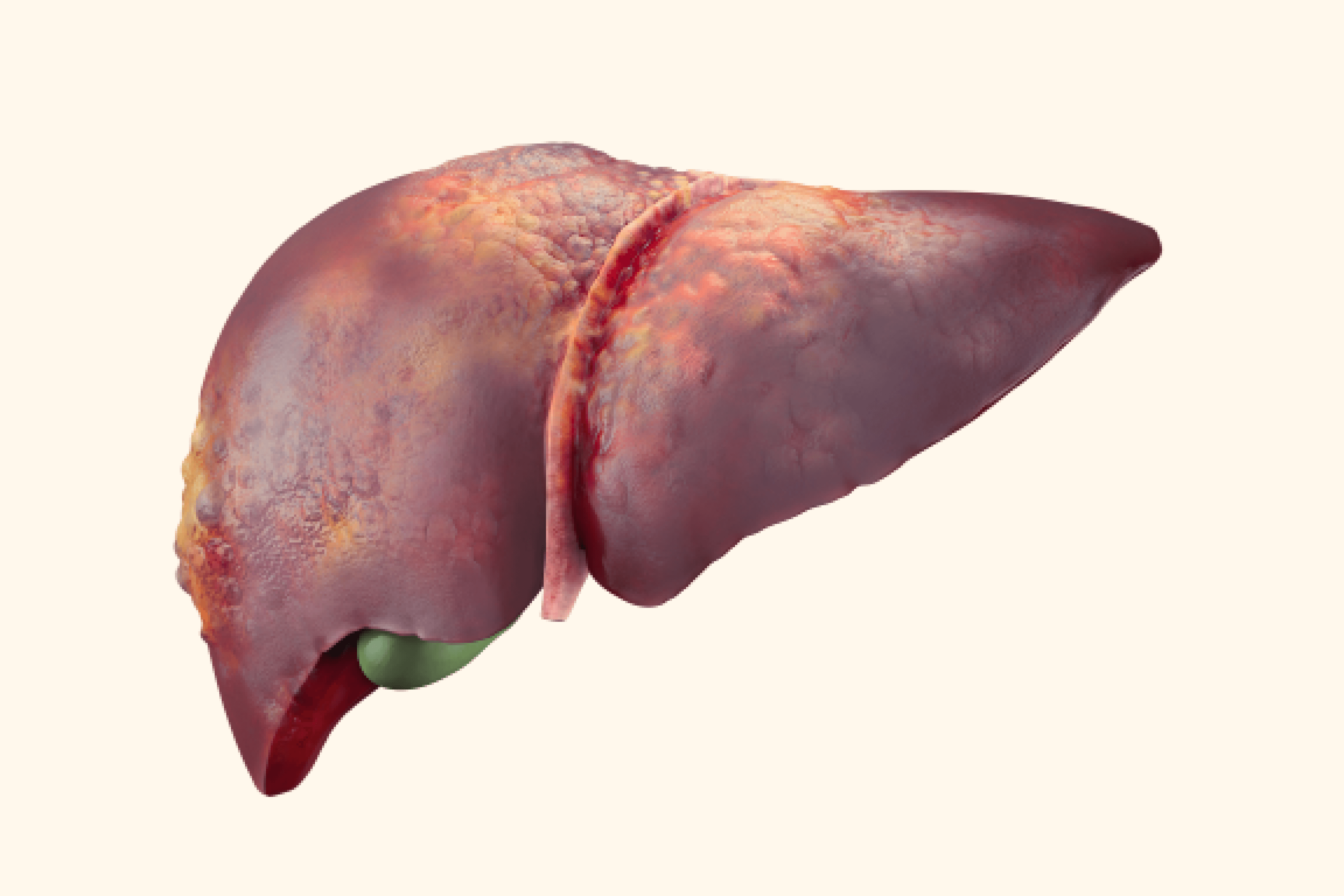 Hepatitis: Your Guide To Staying Safe